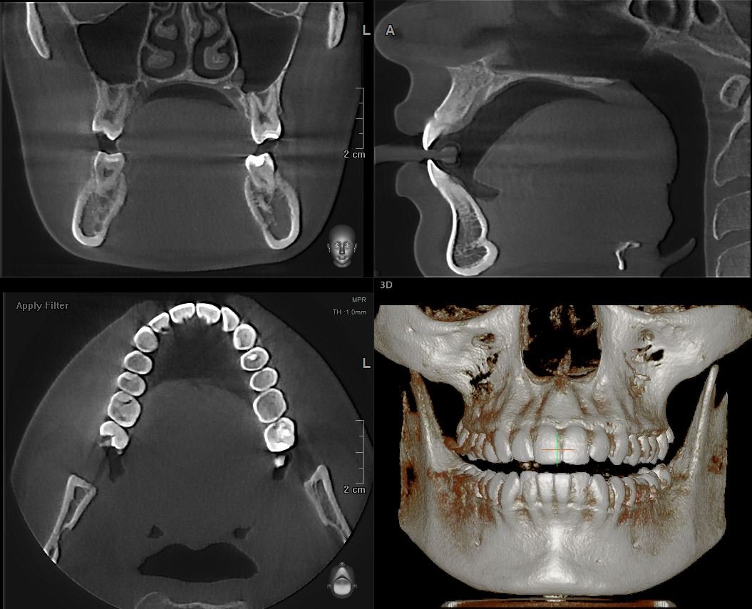 Снимок зуба Томск Магнитогорский Импланты Nobel Biocare Томск Выборгский