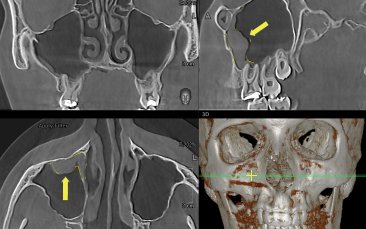 3D, КТ костей лицевого отдела черепа в разных плоскостях